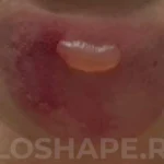 Обморожение второй степени после процедуры криолиполиза