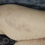 Синяки после вибромассажа