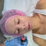РФ после процедуры подтяжки лица